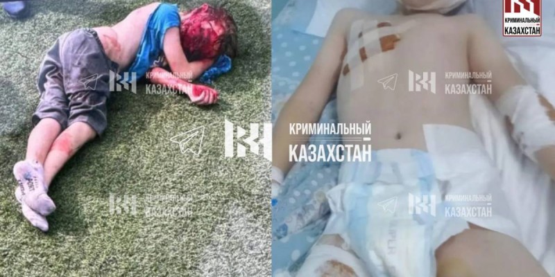 Врачи рассказали о состоянии истерзанного собаками мальчика.